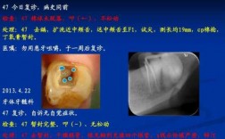 根管牙修复科技知识点总结（根管牙修复科技知识点总结怎么写）