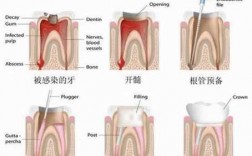 根管牙修复科技知识讲解（根管牙修复科技知识讲解）