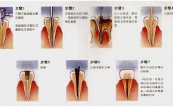 根管牙修复科技知识点（根管治疗后修复方案的选择）