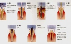 根管牙修复科技知识点视频（根管治疗后牙体修复的材料和方法）