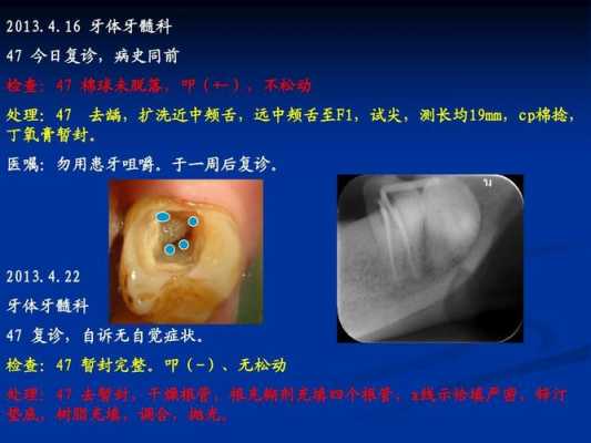 根管牙修复科技知识点总结（根管牙修复科技知识点总结怎么写）-图1