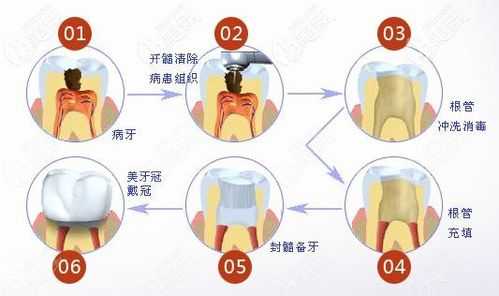 根管牙修复科技知识培训（根管修复要多少钱）-图1