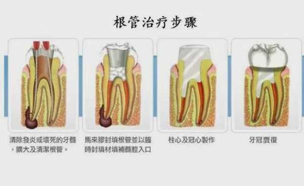 根管牙修复科技知识点汇总（根管治疗后牙体修复的材料与方法）-图2