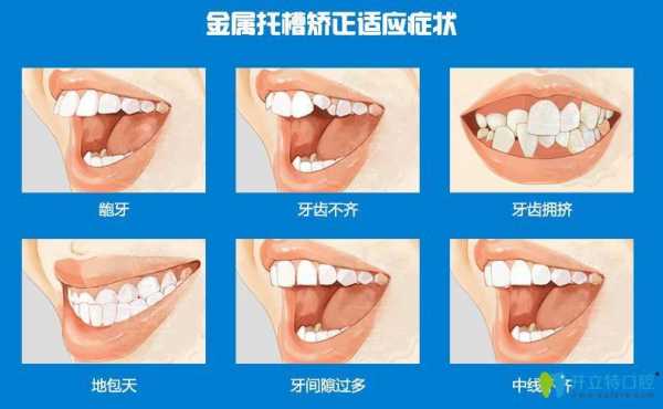 矫正牙齿科技知识点大全（矫正牙齿的最新科技）-图2