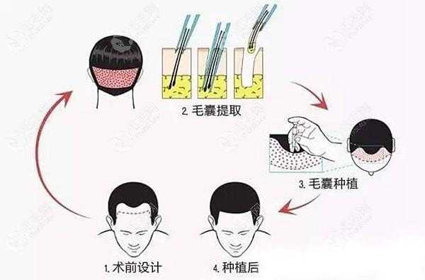 纤维植入科技知识宣传图片（纤维植发是什么意思）-图1