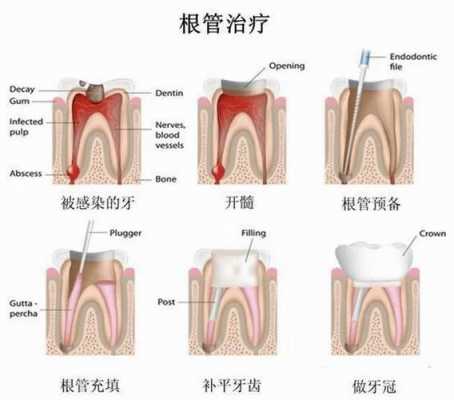 根管牙修复科技知识讲解（根管牙修复科技知识讲解）-图1