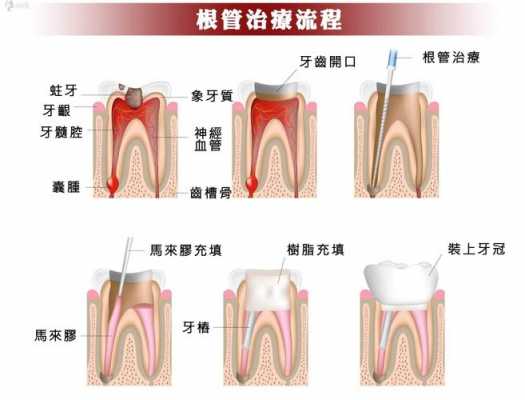 根管牙修复科技知识讲解（根管牙修复科技知识讲解）-图3