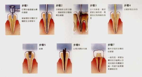 根管牙修复科技知识点视频（根管治疗后牙体修复的材料和方法）-图1