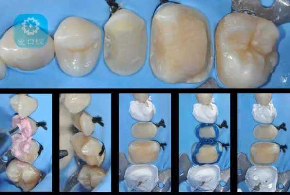 根管牙修复科技知识点视频（根管治疗后牙体修复的材料和方法）-图2