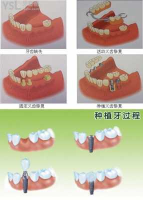 老年假牙修复科技知识培训（老年人 活动假牙 流程）-图2