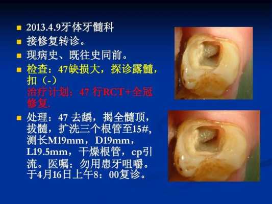 根管牙修复科技知识点（根管治疗后修复方案的选择）-图3